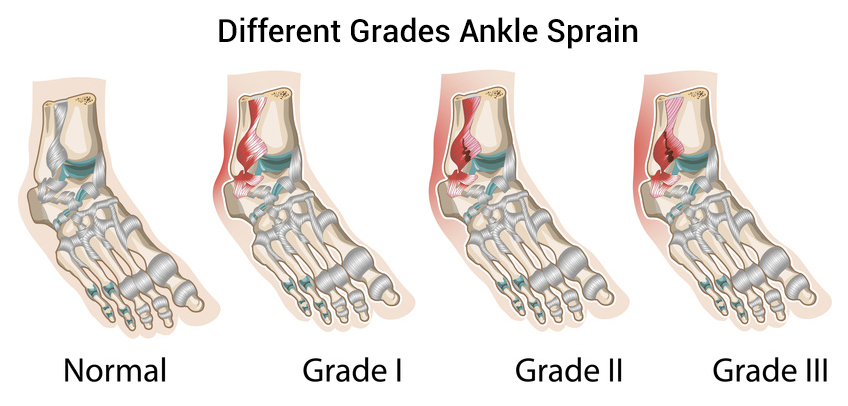 Ankle Sprain Grades