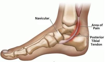 birkenstock for posterior tibial tendonitis