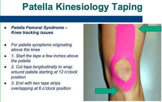 Patellofemoral Pain Syndrome Taping