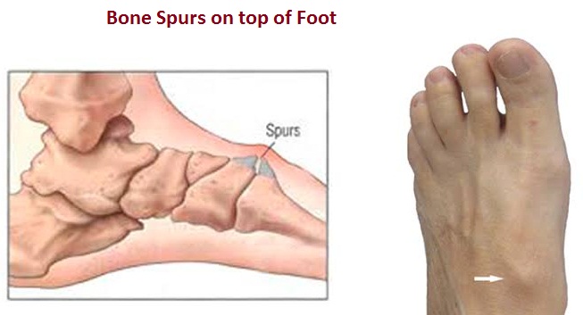 Bone Spurs on top of Foot