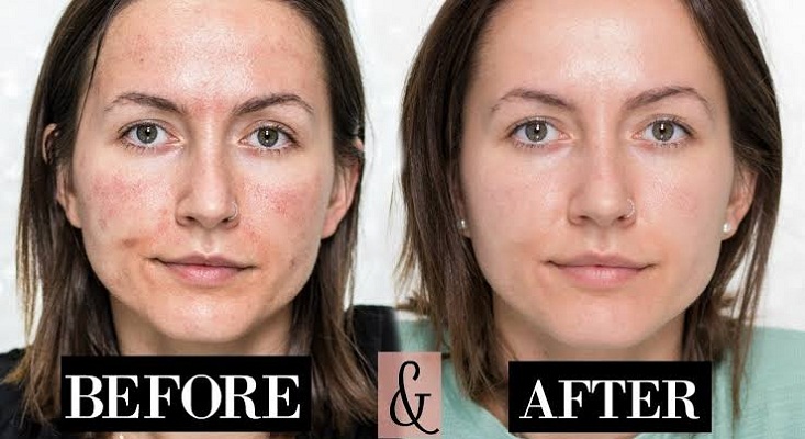 Microneedling Before and After