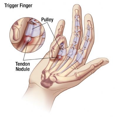 trigger finger anatomy