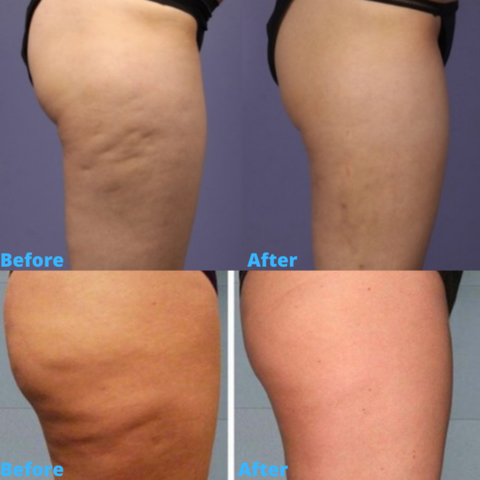 Cupping For Cellulite Before And After Pictures