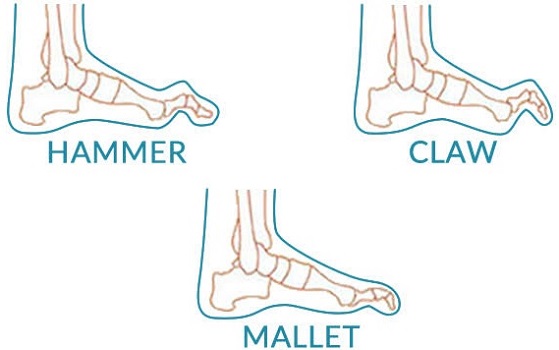 Hammer, Claw & Mallet Toe