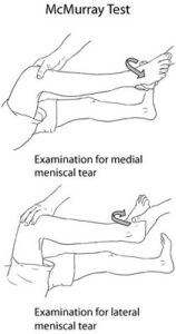 Medial Meniscus Tear Treatment Plan & Exercises - Your Health Guidelines