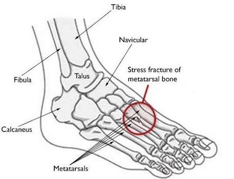 Stress Fractures on the Feet Bones