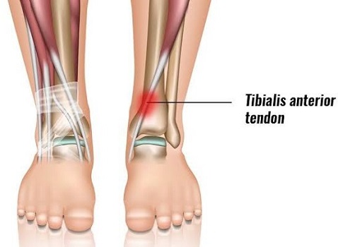 Tibialis Anterior Tendonitis