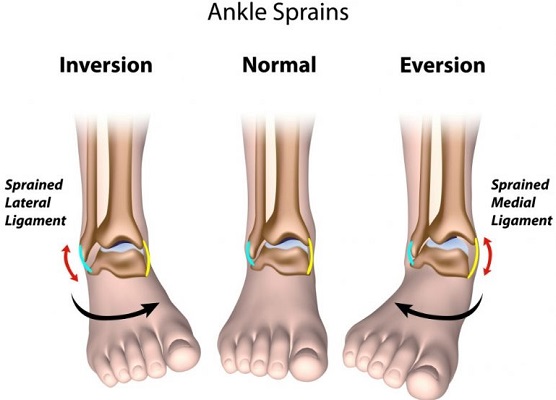ankle sprain ligament