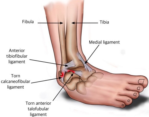 ankle sprain pictures