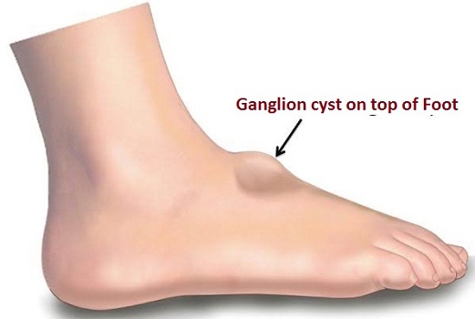 ganglion cyst on top of foot