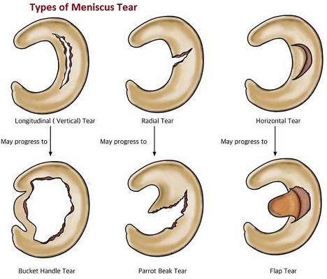 types of meniscus tear