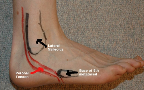 Peroneal Tendonitis Symptoms