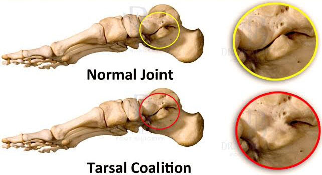 Tarsal Coalition