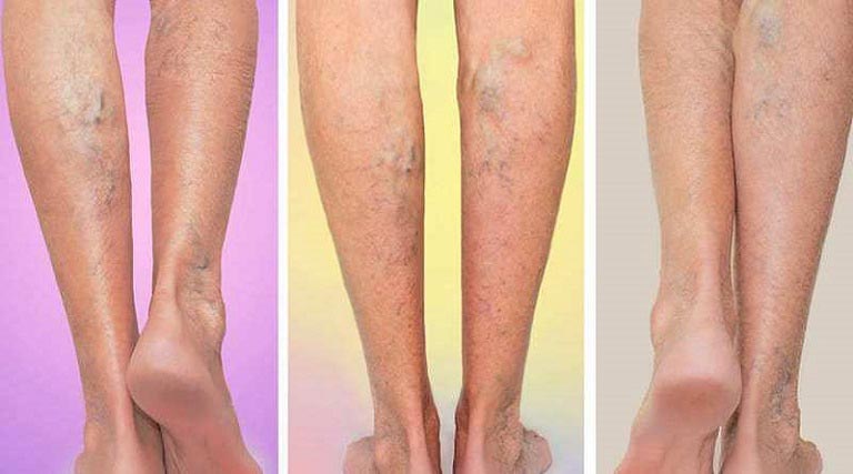 varicose veins symptoms